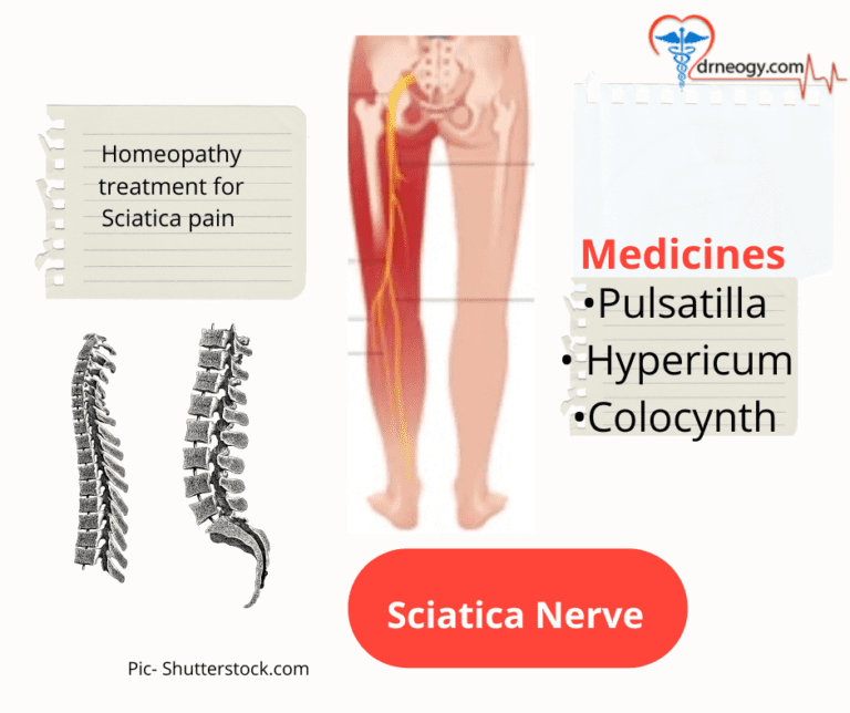 treatment for sciatica pain homeopathy remedies