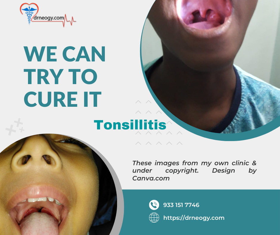 Homeopathy treatment for Tonsillitis and Throat pain