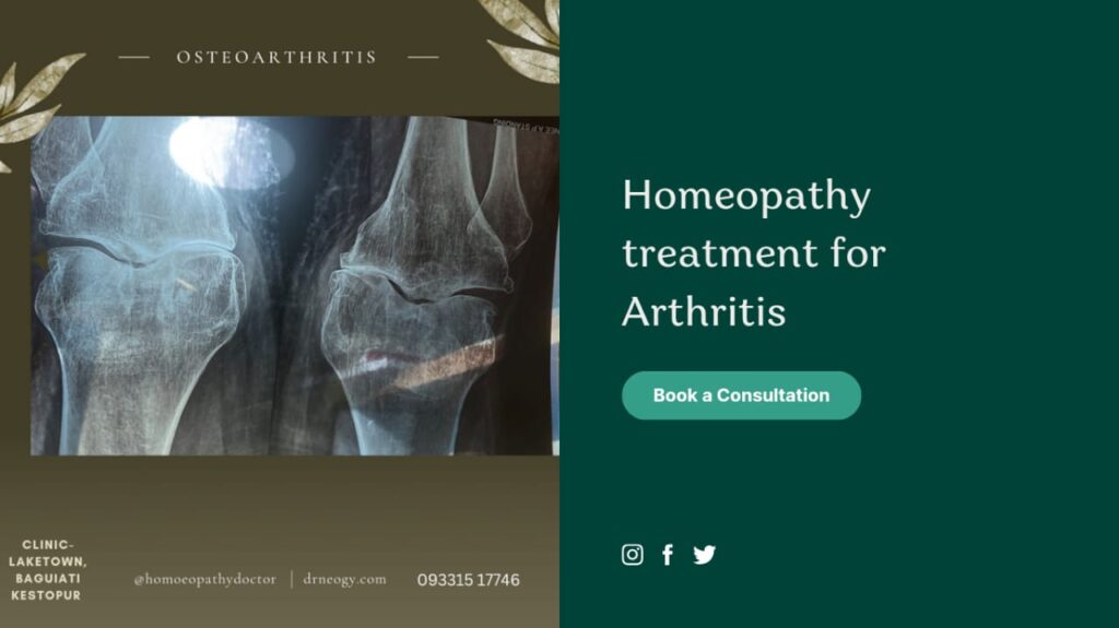 Best homeopathy treatment for osteoarthritis 