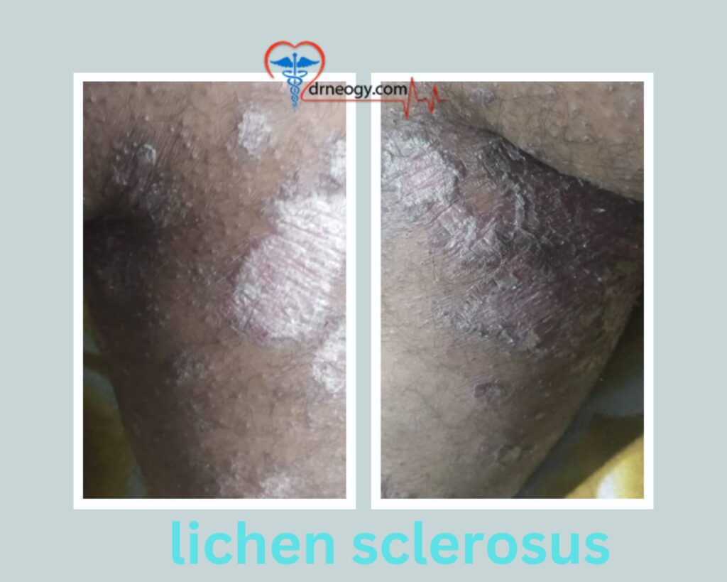 lichen sclerosus treatment