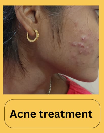 Cure Acne with Homeopathy 